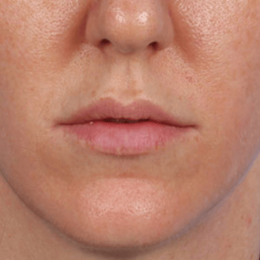 10 Best Clinics for Lip Augmentation in Vietnam [2020 Prices]