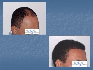 10 Best Clinics For Hair Restoration In Dominican Republic 2020