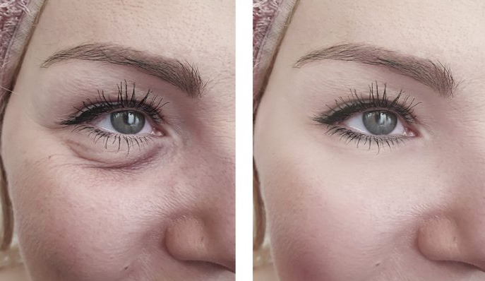 How to Remove Bags Under Eyes Permanently or Instantly  PERFECT