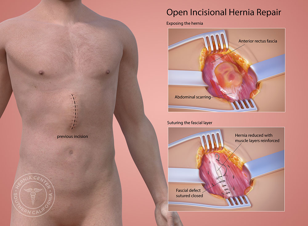 10-best-clinics-for-incisional-hernia-repair-in-hungary-2023-prices