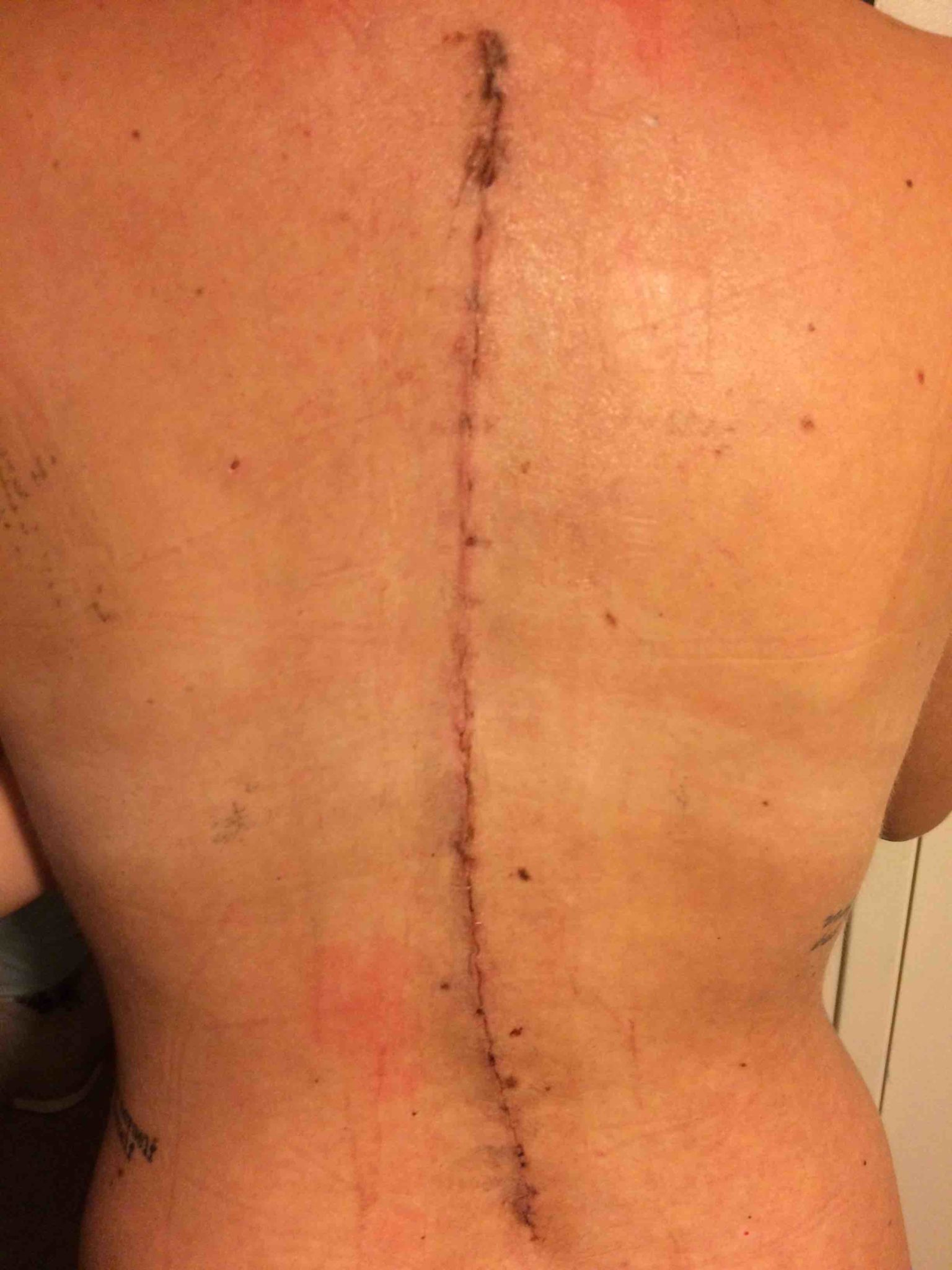 My Two Year Post Spinal Fusion Surgery Update