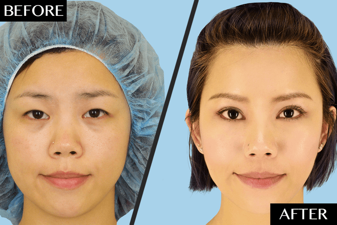 how much is eyelid surgery in korea