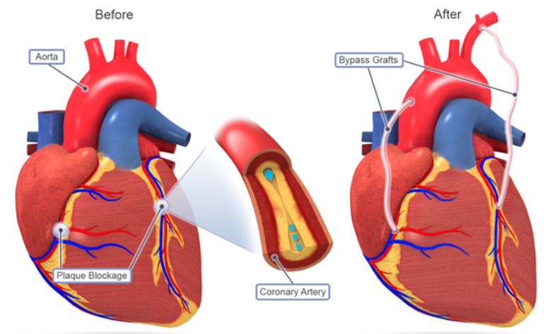 10 Best Clinics For Coronary Artery Bypass Graft (CABG) Surgery In Al ...