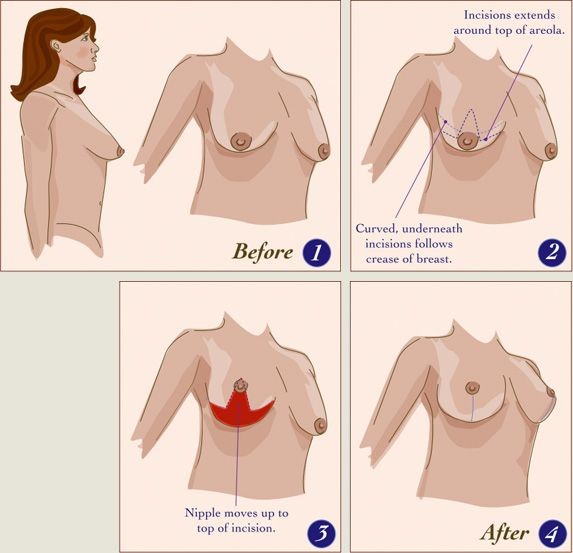 10 Best Clinics for Breast Lift in Switzerland (w/Prices)