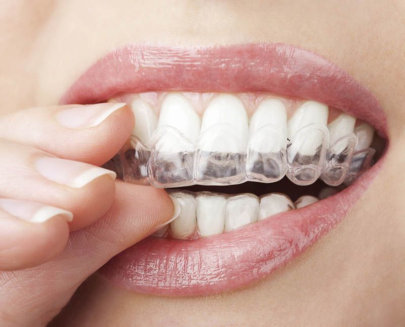 Best Malaysia for Invisalign [2020 in Clinics 10 Prices]